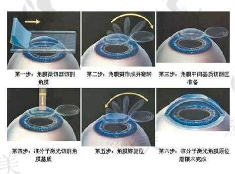 国 家是否提倡做近视眼手术？