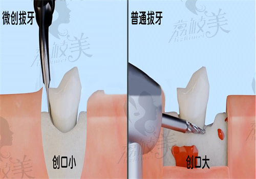 拔牙拆线一般要七天可以拆