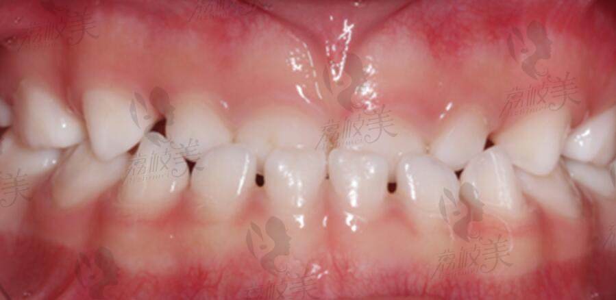 骨性前牙反合，俗称“地包天”，是一种常见的错合畸形