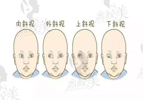 孩子斜视眼怎么造成的？