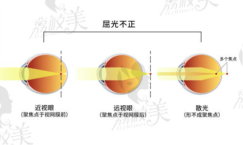 成都屈光手术医院排名