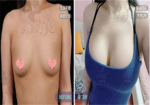 北京美莱高超假体隆胸案 例
