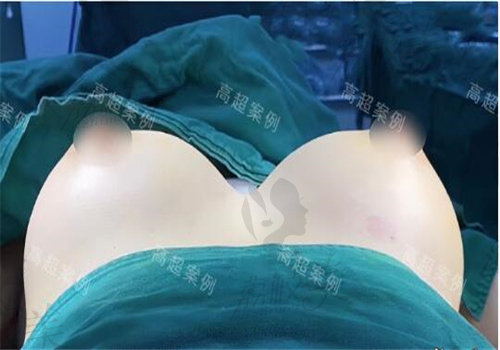 北京美莱高超假体隆胸技术好