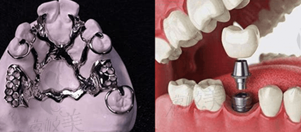 活动义齿和种植牙
