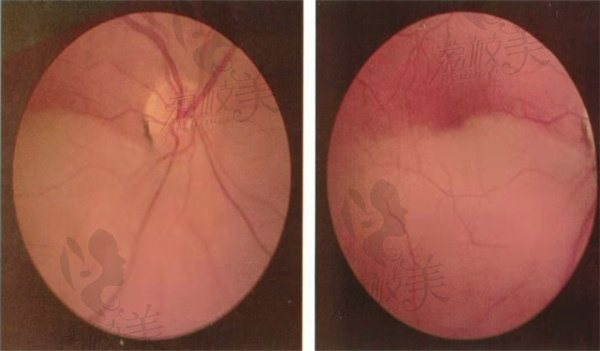 视网膜中央动脉阻塞的原因可能与以下因素有关