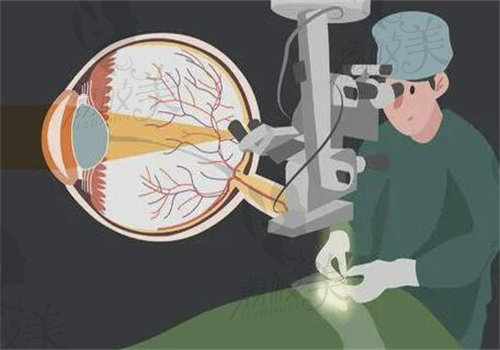 准分子激光手术和飞秒区别