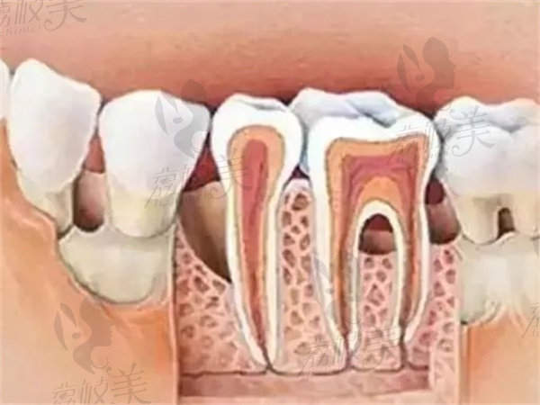 牙根外露是什么原因造成的