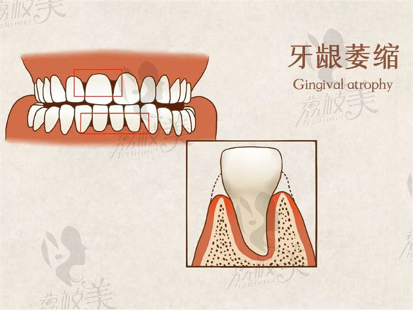 牙根外露是什么原因造成的
