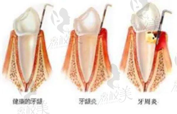 牙周炎病变过程