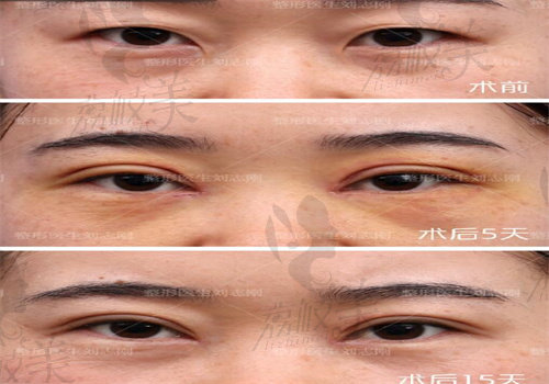 刘志刚案 例一：双眼皮手术