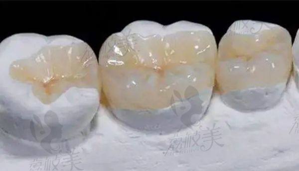 树脂材料补牙