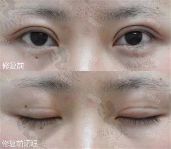 长沙爱思特张娇娇做眼修复费用真不高