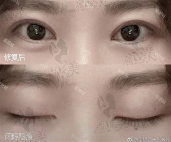 长沙爱思特张娇娇做眼修复费用真不高