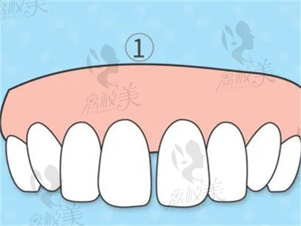 门牙缝隙大是什么原因导致的