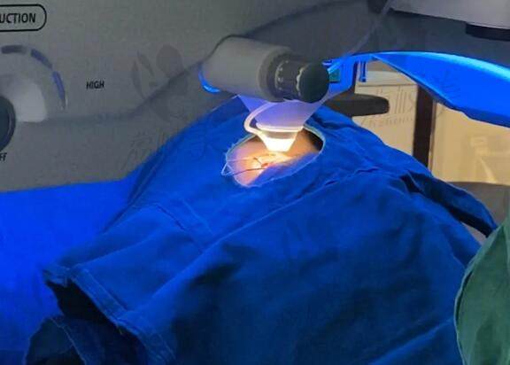 泰州张勤眼科医院做近视激光手术中