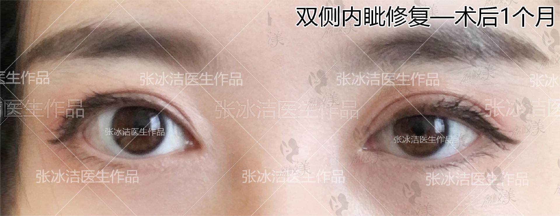 北京张冰洁修复双眼皮技术贼好