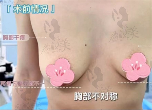 长沙美莱林飙斌隆胸<span style= 长沙美莱林飙斌隆胸<span style=