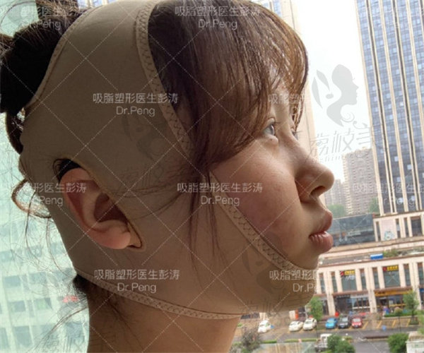杭州格莱美彭涛吸脂 杭州格莱美彭涛吸脂
