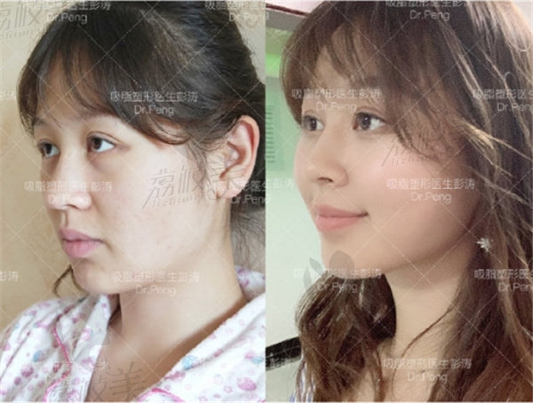 杭州格莱美彭涛吸脂 杭州格莱美彭涛吸脂