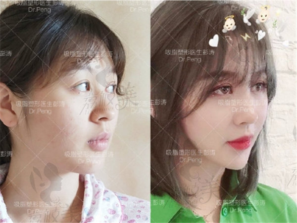 杭州格莱美彭涛吸脂 杭州格莱美彭涛吸脂