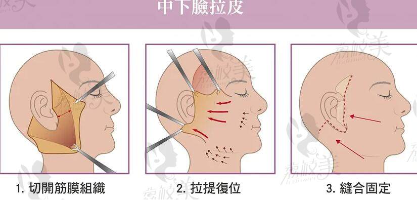 北京穆宝安可以做面部提升手术吗