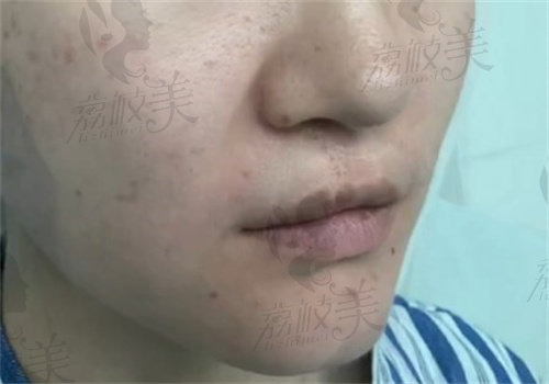 北京马群医生唇腭裂修复例子