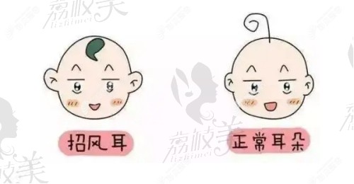 精靈耳和招風(fēng)耳有啥區(qū)別?