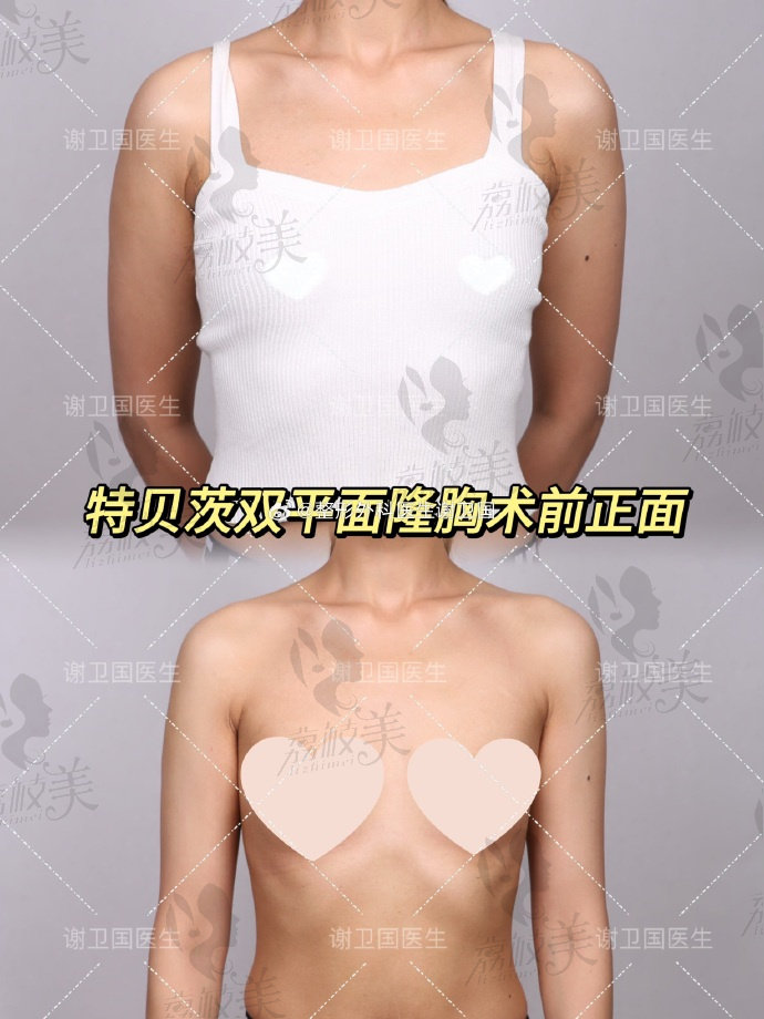 上海谢卫国假体隆胸技术好