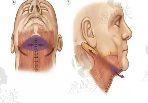 颈阔肌成形术的好处是什么