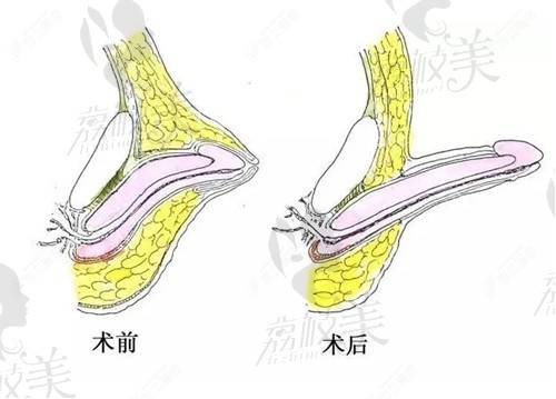 程氏陰莖再造術(shù)