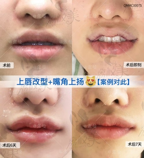 北京张曼做唇怎样？
