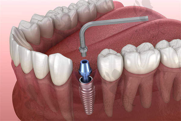 3D数字化种植牙有什么优势