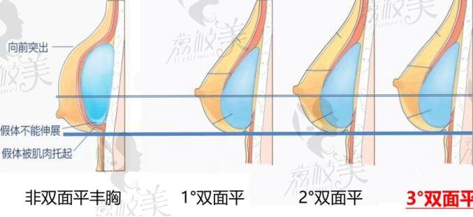 武汉徐国建做胸怎么样