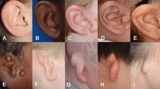 各类耳畸形病例展示