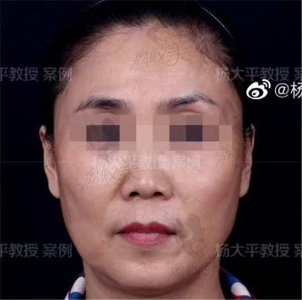 北京杨大平的面部提升切口位置在发际线