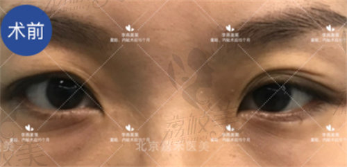 李燕双眼皮手术成功案 例