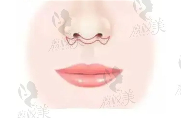 卢九宁人中缩短术做得好 卢九宁人中缩短术做得好