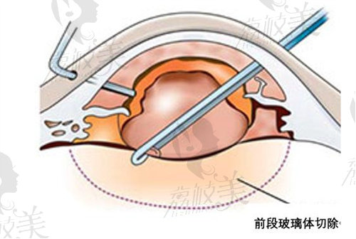 玻切手术费用大概多少