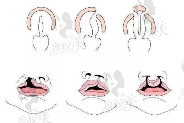 唇腭裂的几种表现