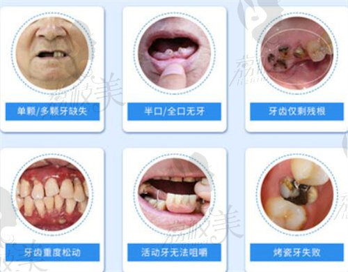 广大口腔西湾门诊部各种缺牙问题