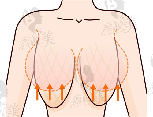 深圳乳房下垂矫正医生推荐