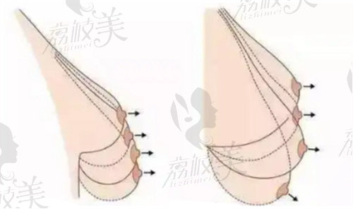 深圳乳房下垂矫正哪家医院好？