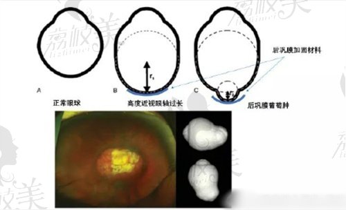 王樂今后鞏膜加固術(shù)手術(shù)材料