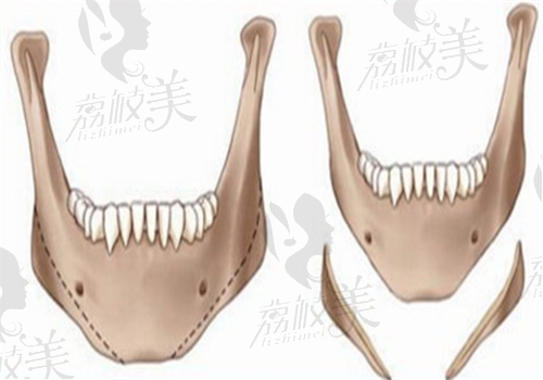 西安國醫(yī)整形醫(yī)院磨骨手術(shù)圖