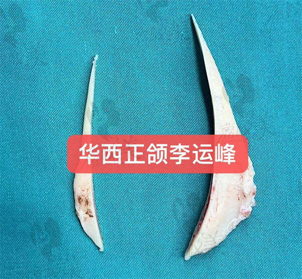 李运峰磨骨怎么样