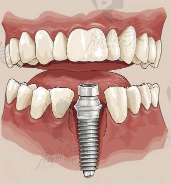 牙博士口腔种植牙好吗