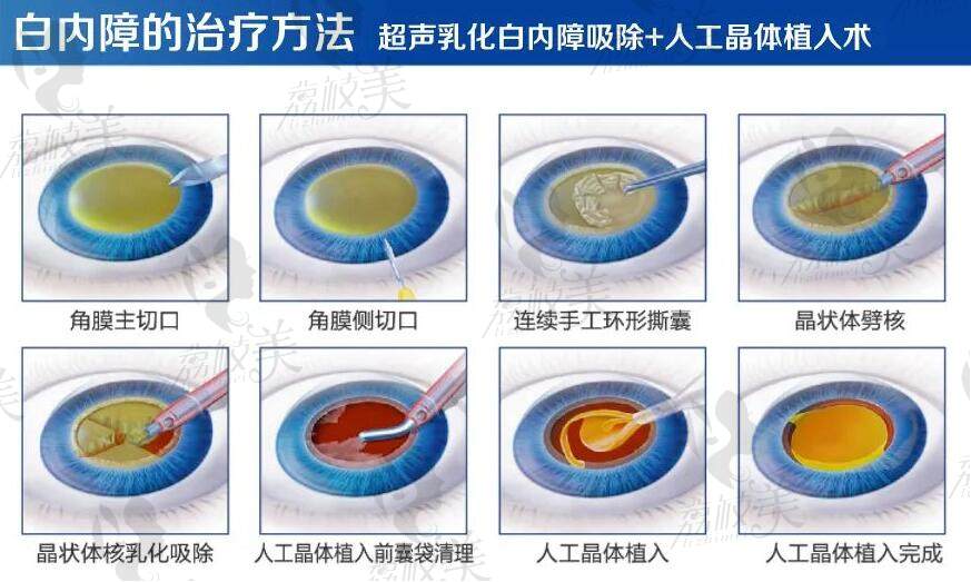 揭阳希玛林顺潮眼科医院白内障治疗怎么样？