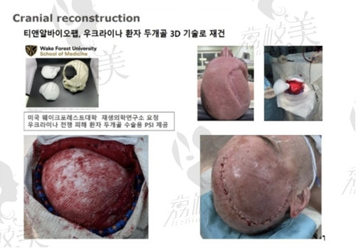 韩国欧佩拉整形外科PCL补骨
