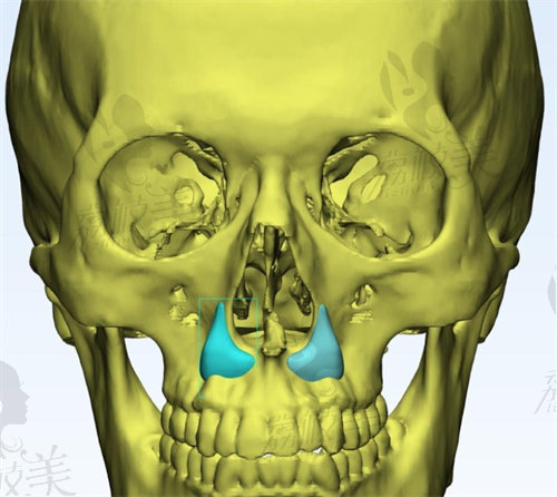 张策医生3D打印鼻基底