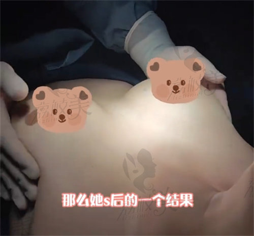 武汉五洲葛海辉医生假体隆胸手术做怎么样